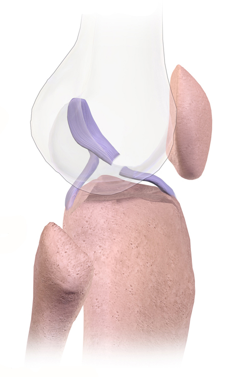 Rupture du ligament croisé antérieur (LCA)