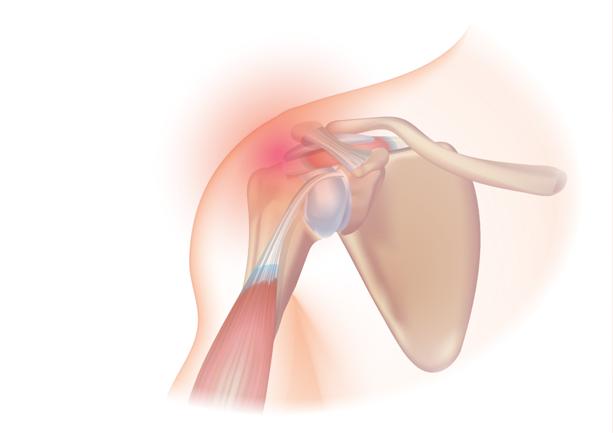 Tendinopathie de la coiffe des rotateurs